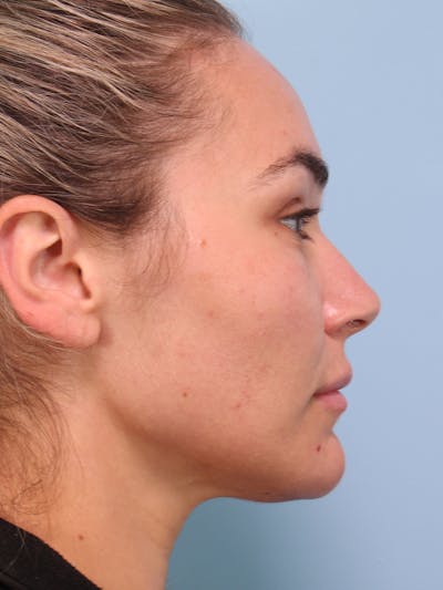 Thread Lift Before & After Gallery - Patient 228155 - Image 2