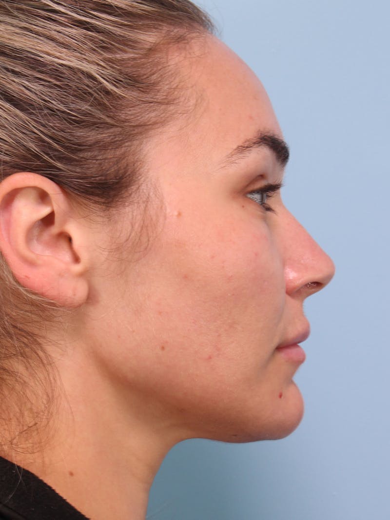 Thread Lift Before & After Gallery - Patient 228155 - Image 2