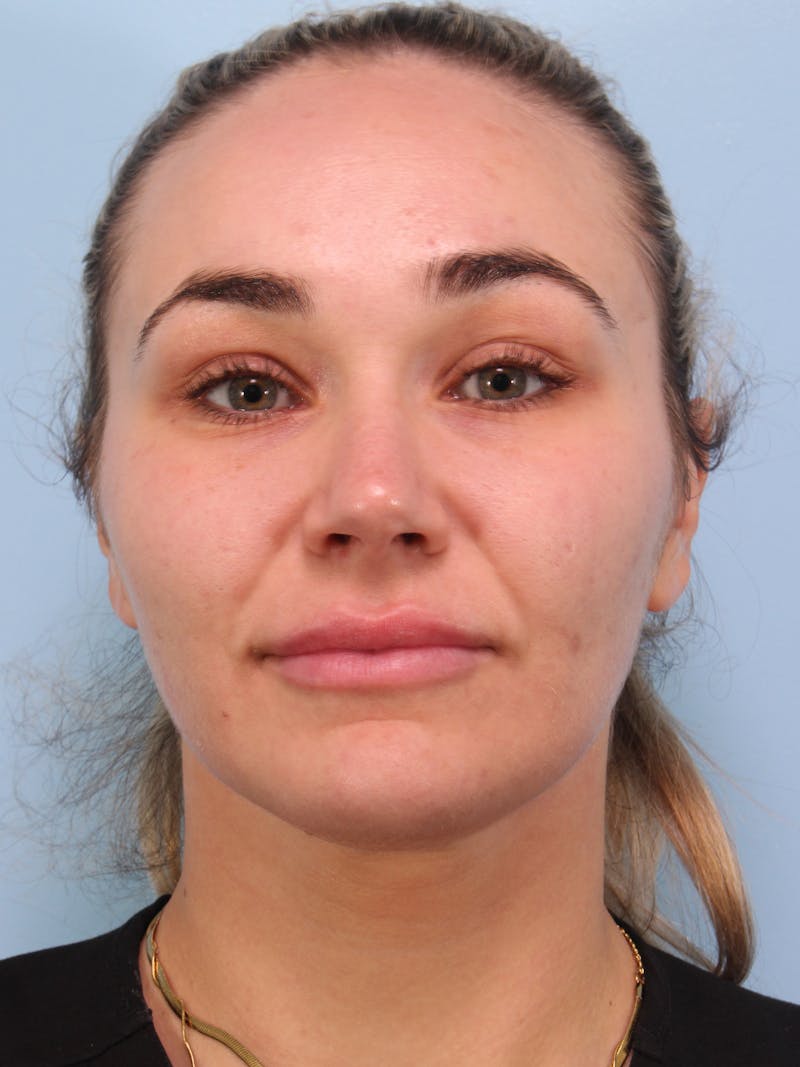 Thread Lift Before & After Gallery - Patient 228155 - Image 3