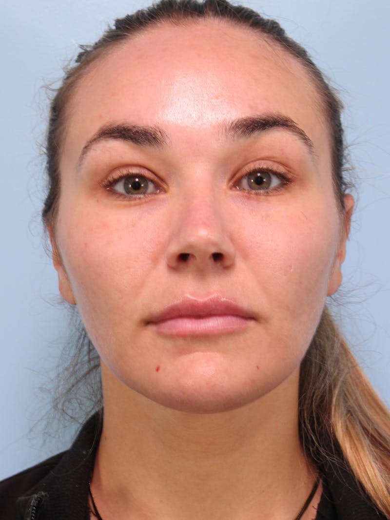 Thread Lift Before & After Gallery - Patient 228155 - Image 4