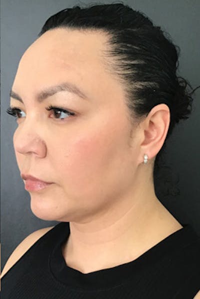 Ultherapy Before & After Gallery - Patient 132143 - Image 2