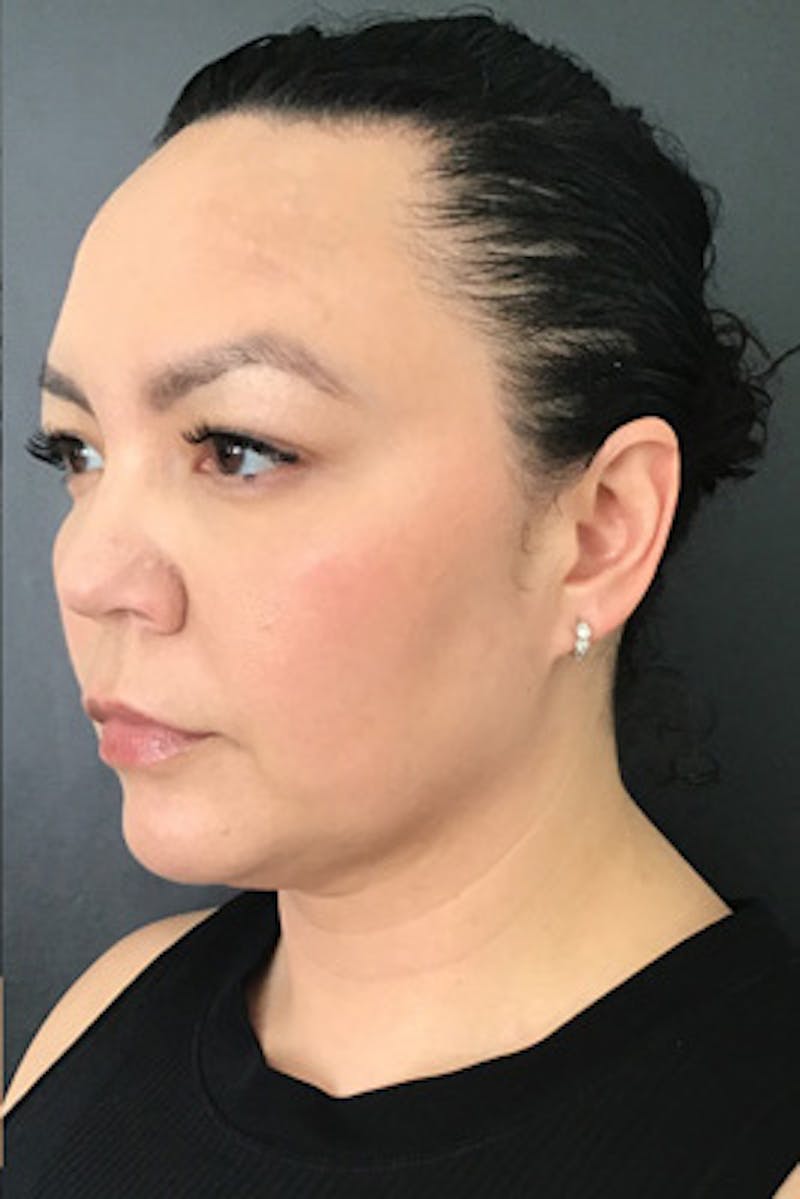 Ultherapy Before & After Gallery - Patient 132143 - Image 2