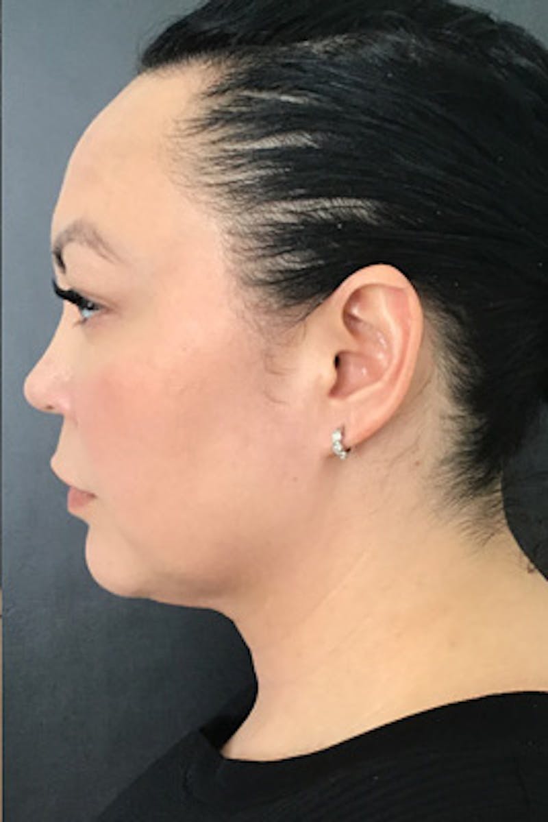 Ultherapy Before & After Gallery - Patient 132143 - Image 4