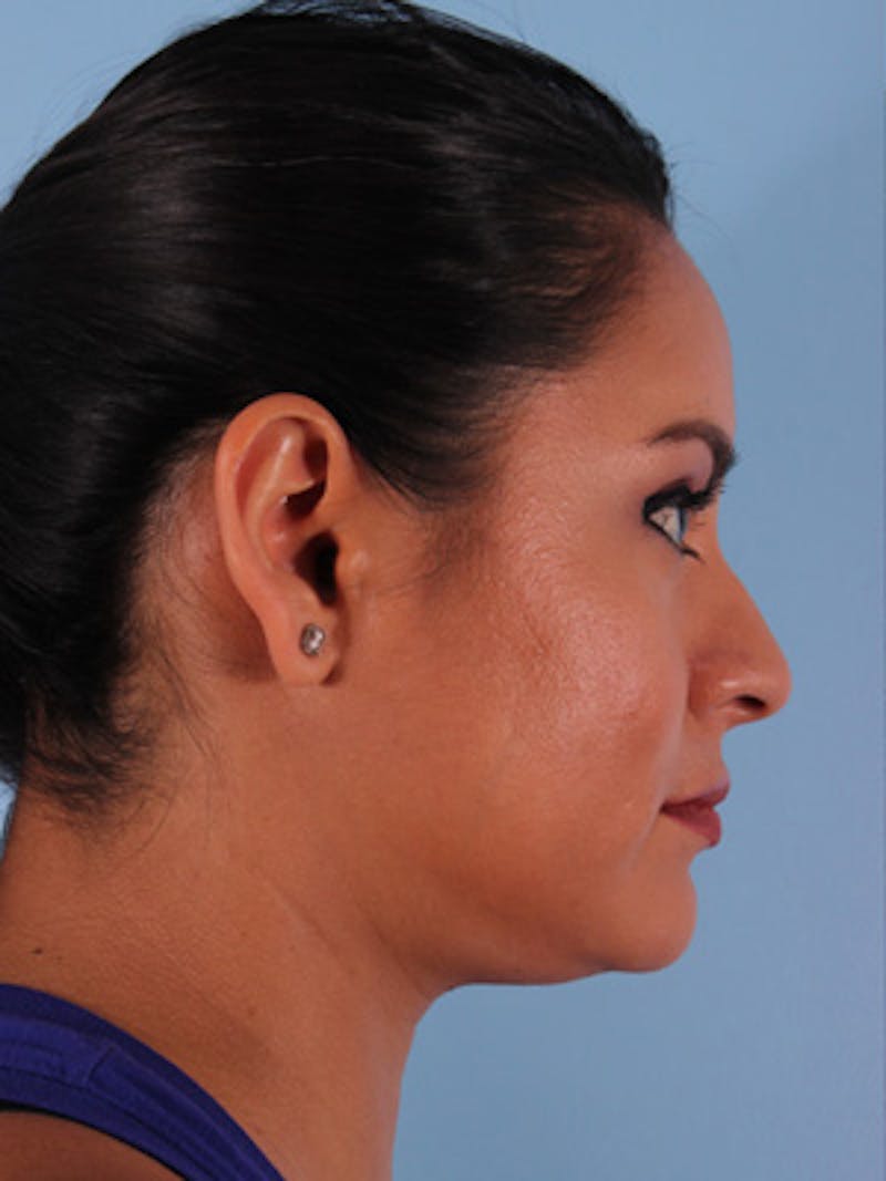 Ultherapy Before & After Gallery - Patient 303806 - Image 3