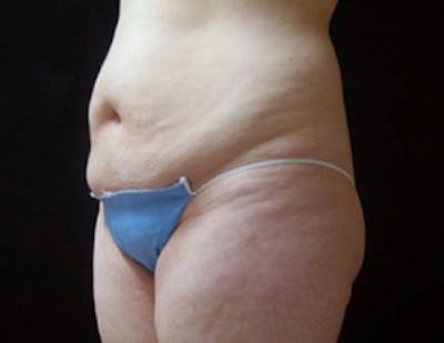 Ultrashape Before & After Gallery - Patient 418388 - Image 1