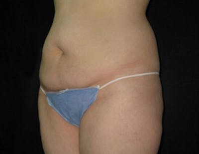 Ultrashape Before & After Gallery - Patient 418388 - Image 2