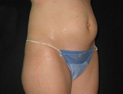Ultrashape Before & After Gallery - Patient 269873 - Image 1