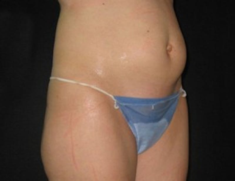 Ultrashape Before & After Gallery - Patient 269873 - Image 1