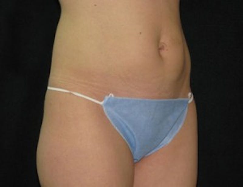 Ultrashape Before & After Gallery - Patient 269873 - Image 2