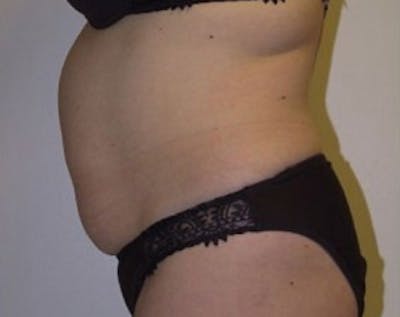 Ultrashape Before & After Gallery - Patient 207433 - Image 1