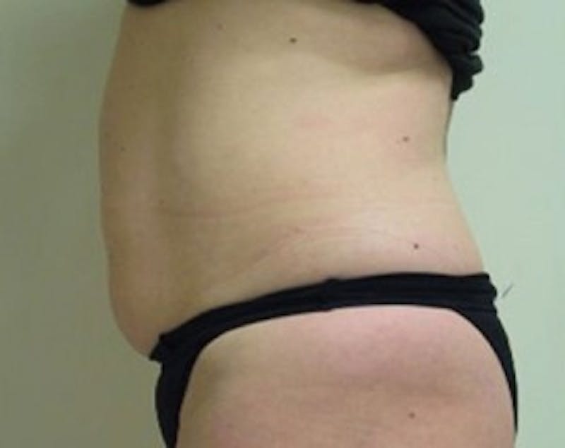 Ultrashape Before & After Gallery - Patient 207433 - Image 2