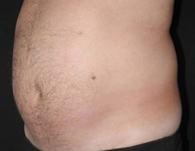 Ultrashape Before & After Gallery - Patient 643906 - Image 1