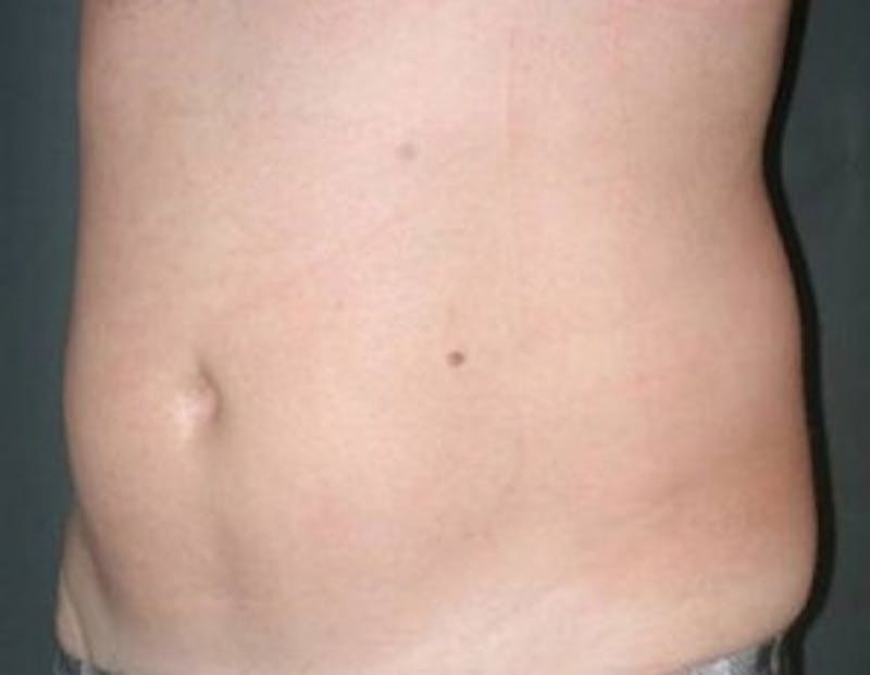 Ultrashape Before & After Gallery - Patient 643906 - Image 2