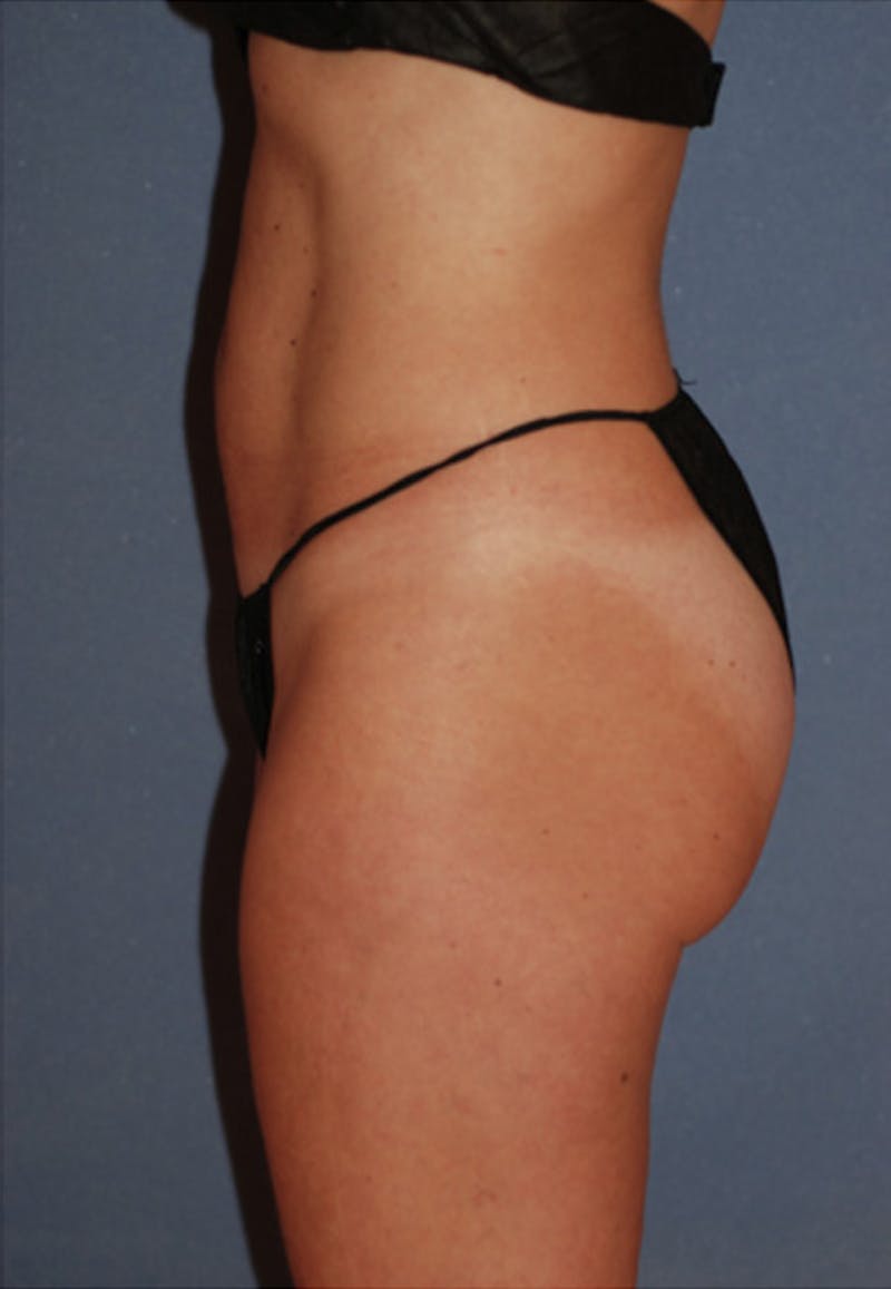 Ultrashape Before & After Gallery - Patient 593973 - Image 2