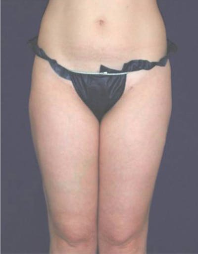 Ultrashape Before & After Gallery - Patient 229627 - Image 2