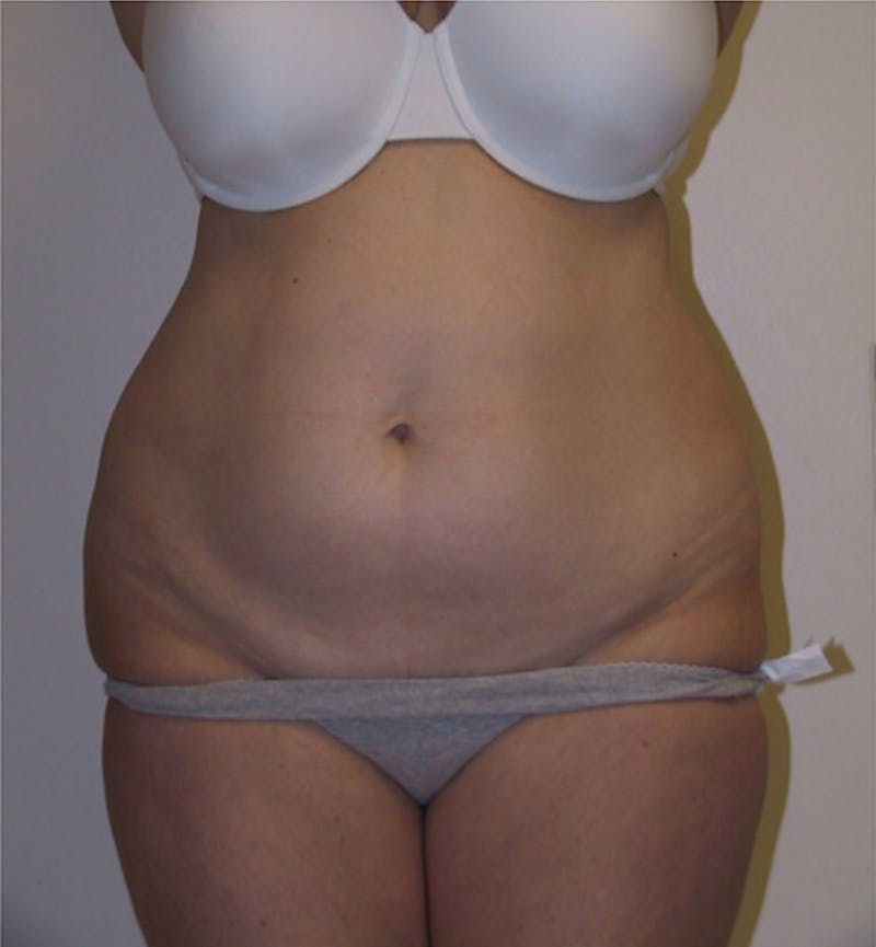 Ultrashape Before & After Gallery - Patient 404263 - Image 1
