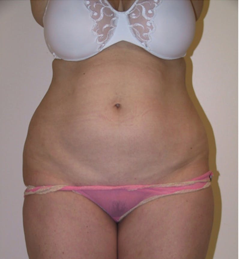 Ultrashape Before & After Gallery - Patient 404263 - Image 2
