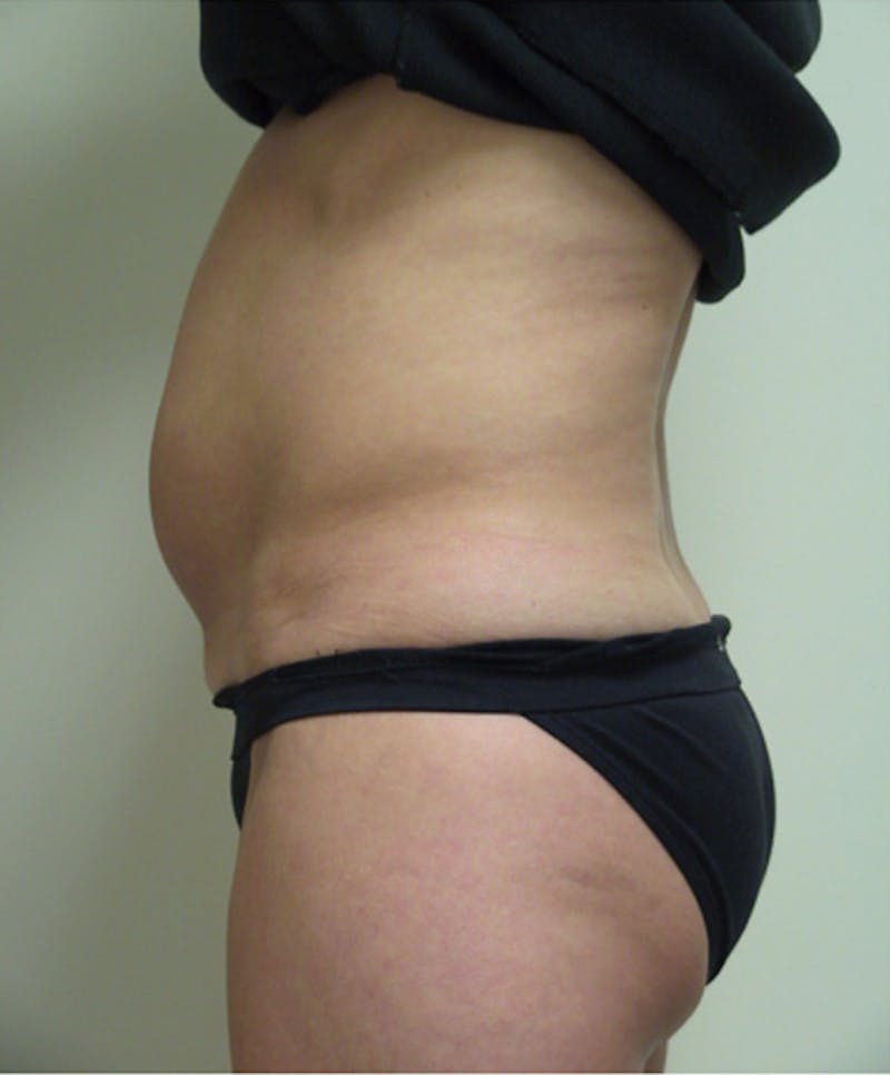 Ultrashape Before & After Gallery - Patient 194925 - Image 1