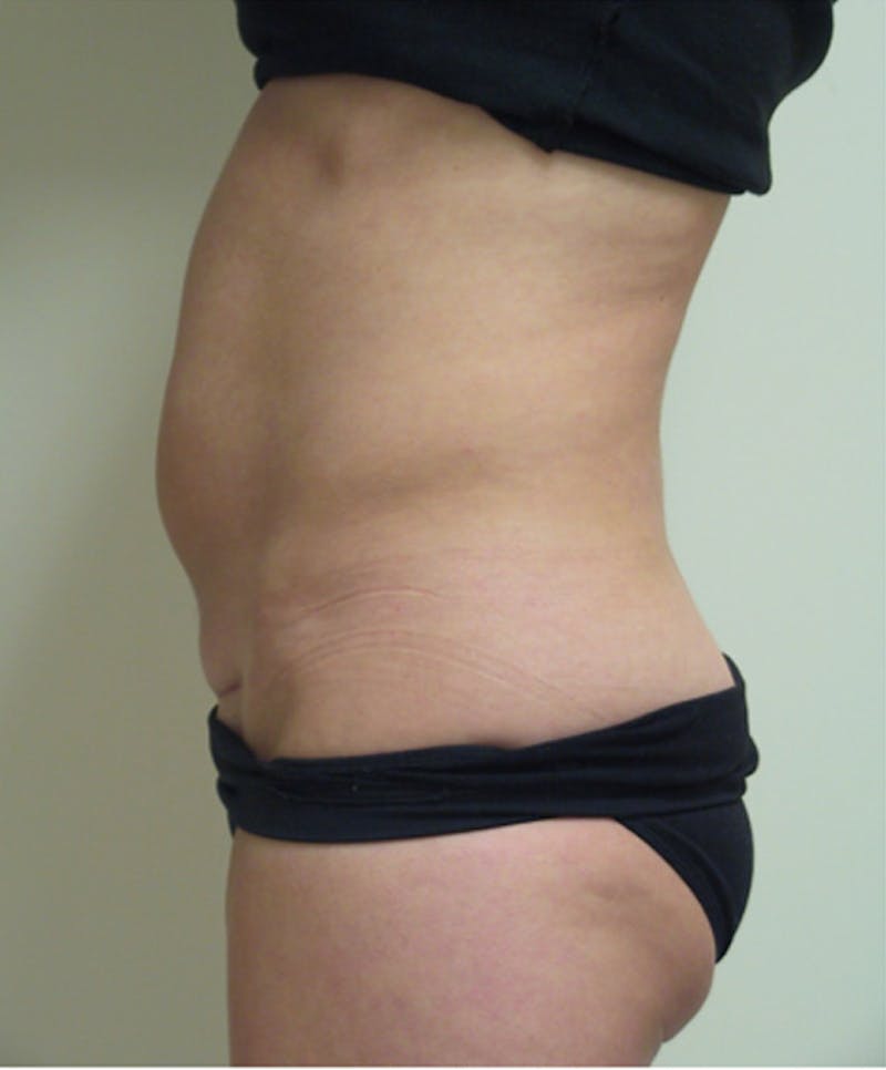 Ultrashape Before & After Gallery - Patient 194925 - Image 2