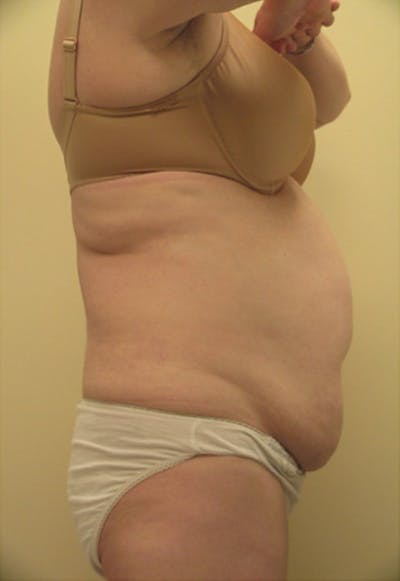 Ultrashape Before & After Gallery - Patient 332593 - Image 1