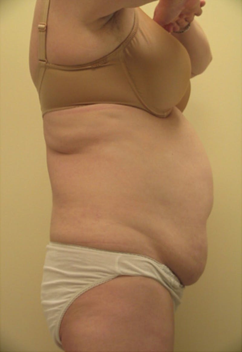 Ultrashape Before & After Gallery - Patient 332593 - Image 1