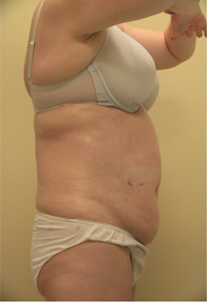 Ultrashape Before & After Gallery - Patient 332593 - Image 2