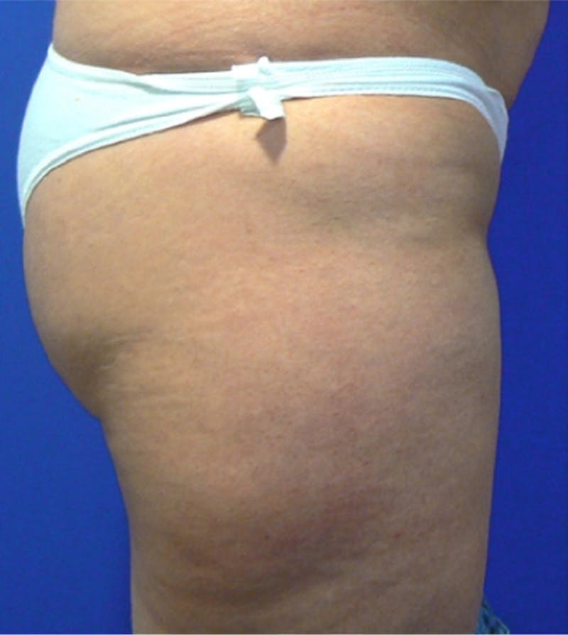 Ultrashape Before & After Gallery - Patient 362174 - Image 1