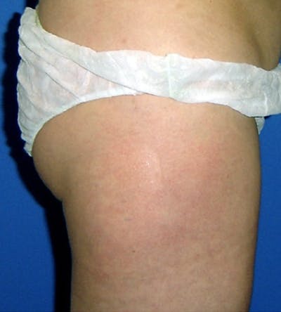 Ultrashape Before & After Gallery - Patient 362174 - Image 2