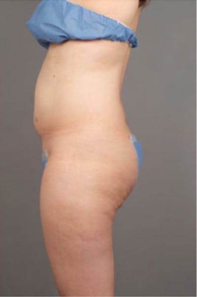 Ultrashape Before & After Gallery - Patient 314308 - Image 1