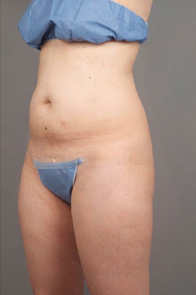 Ultrashape Before & After Gallery - Patient 314308 - Image 3