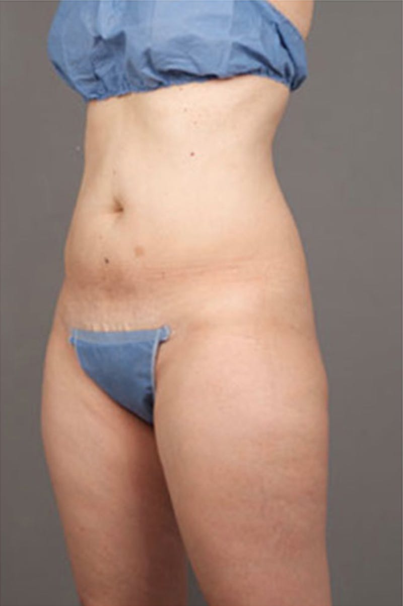 Ultrashape Before & After Gallery - Patient 314308 - Image 4