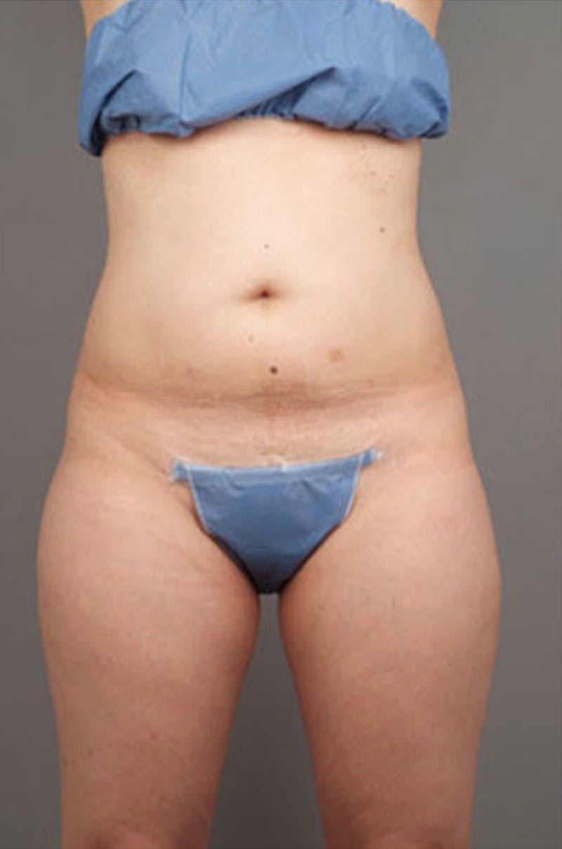 Ultrashape Before & After Gallery - Patient 314308 - Image 5