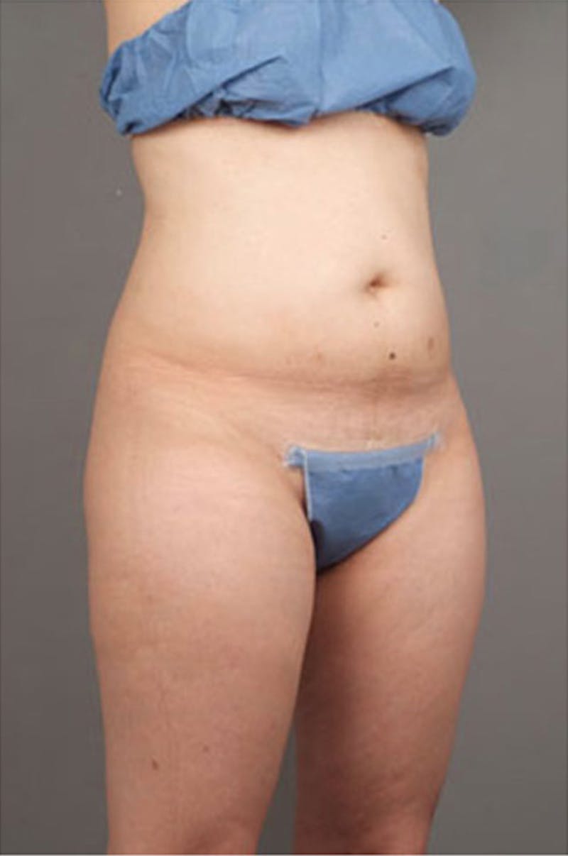 Ultrashape Before & After Gallery - Patient 314308 - Image 7