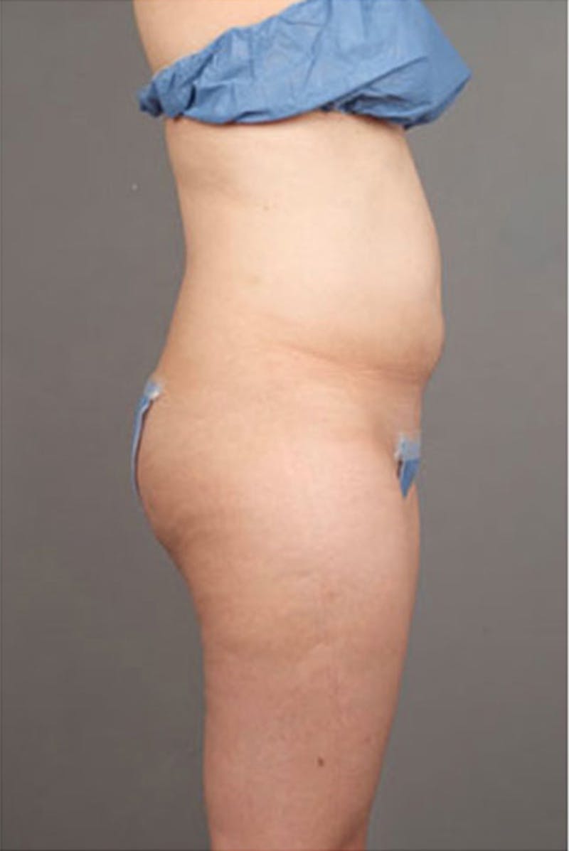 Ultrashape Before & After Gallery - Patient 314308 - Image 9