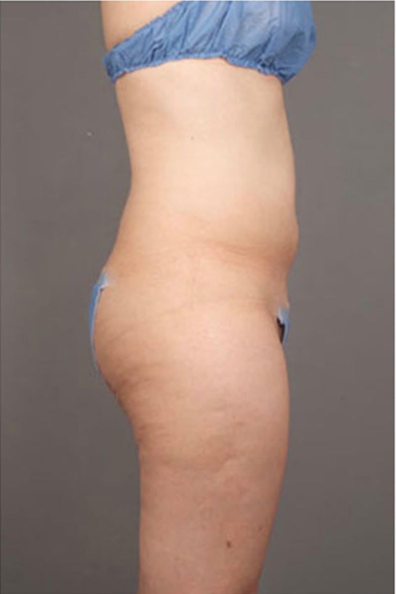 Ultrashape Before & After Gallery - Patient 314308 - Image 10