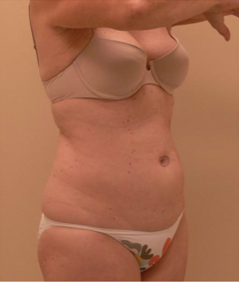 Ultrashape Before & After Gallery - Patient 162295 - Image 1