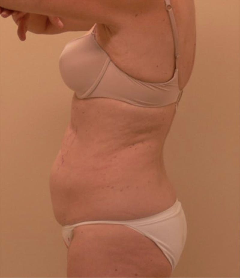 Ultrashape Before & After Gallery - Patient 162295 - Image 3