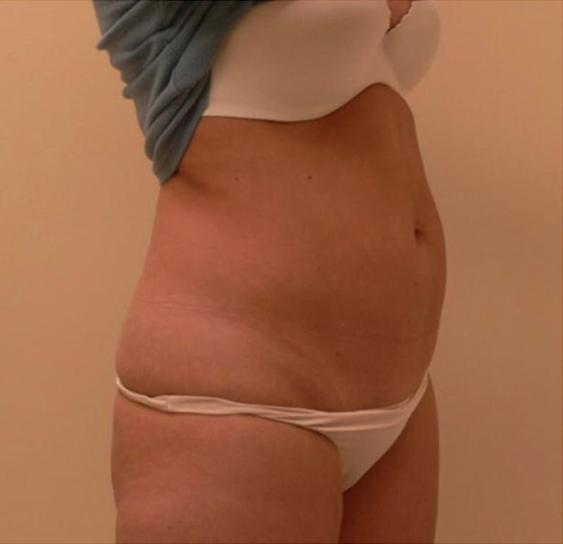 Ultrashape Before & After Gallery - Patient 308813 - Image 1