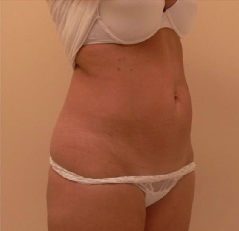 Ultrashape Before & After Gallery - Patient 308813 - Image 2
