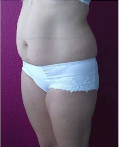 Ultrashape Before & After Gallery - Patient 308125 - Image 1
