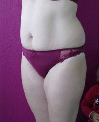 Ultrashape Before & After Gallery - Patient 308125 - Image 2