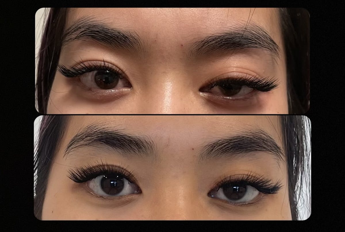 Upneeq Before & After Gallery - Patient 253774 - Image 1