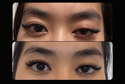 Upneeq Before & After Gallery - Patient 253774 - Image 1