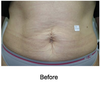VelaShape Before & After Gallery - Patient 176076 - Image 1