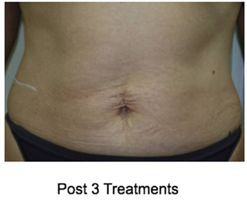 VelaShape Before & After Gallery - Patient 176076 - Image 2