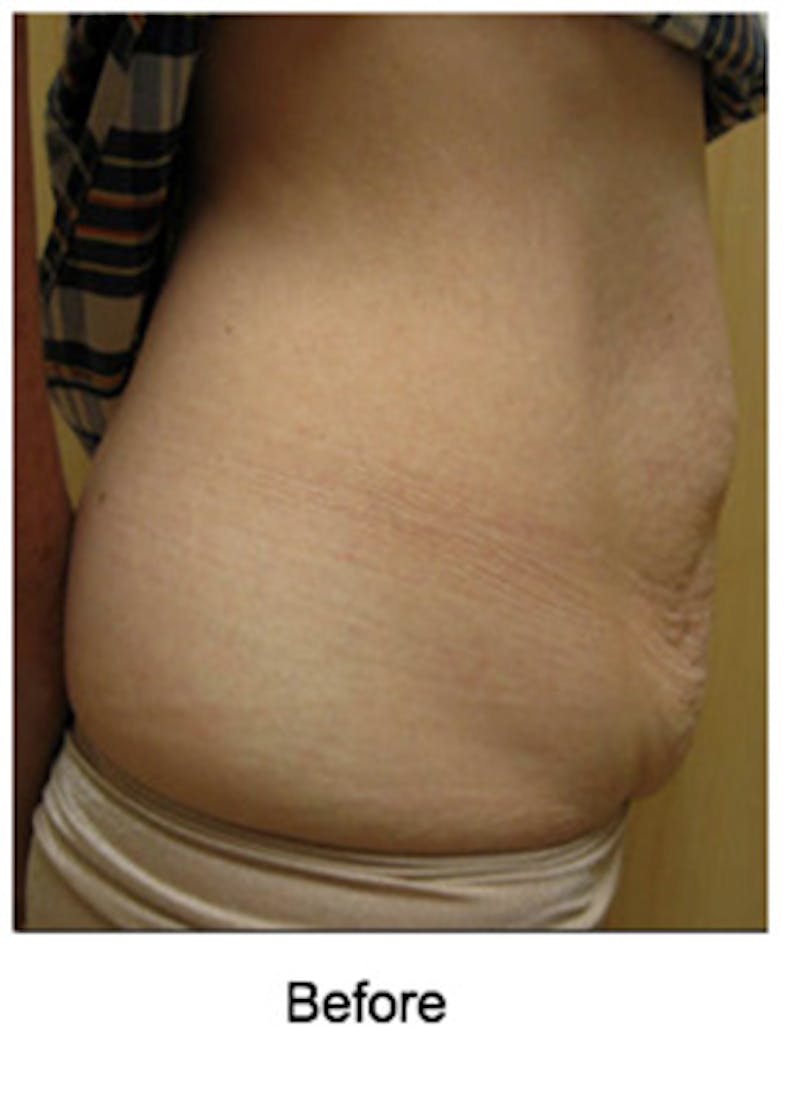 VelaShape Before & After Gallery - Patient 176076 - Image 3