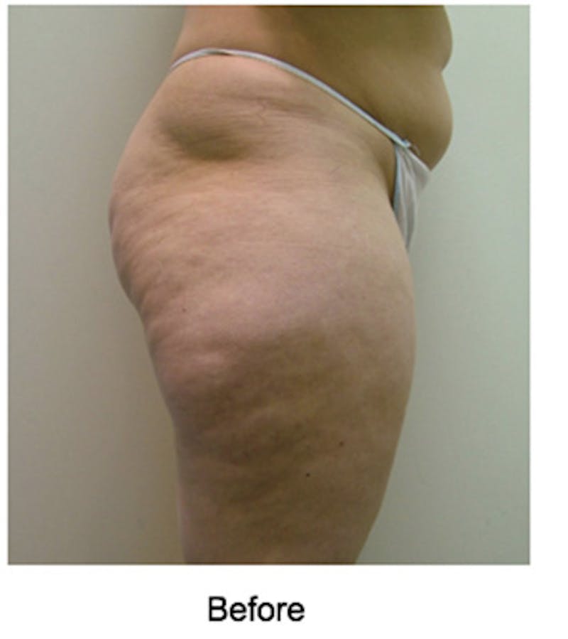 VelaShape Before & After Gallery - Patient 404413 - Image 1