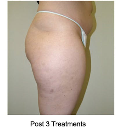 VelaShape Before & After Gallery - Patient 404413 - Image 2