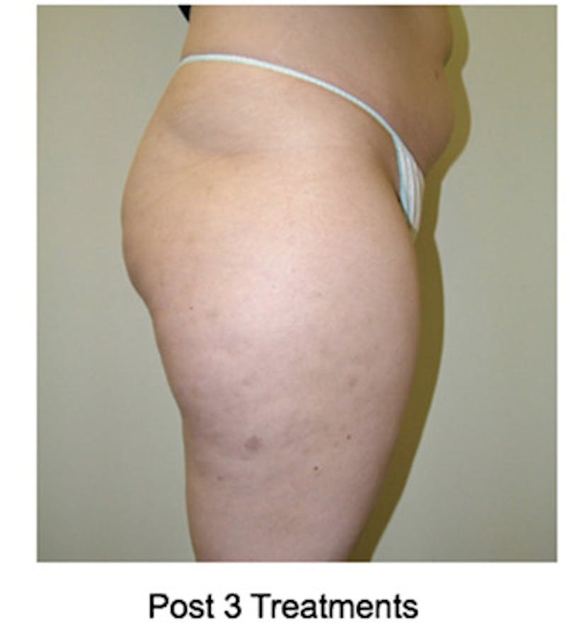 VelaShape Before & After Gallery - Patient 404413 - Image 2