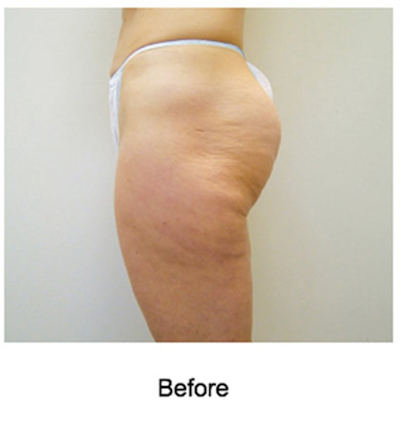 VelaShape Before & After Gallery - Patient 404413 - Image 3